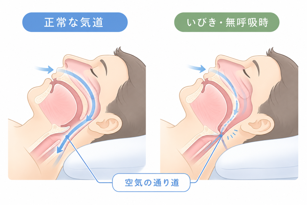 正常な気道と睡眠時無呼吸で狭くなった気道を比較した図
