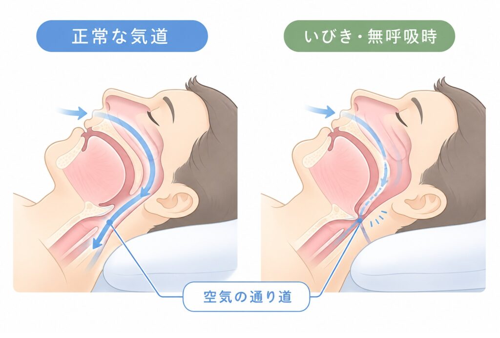正常な気道と睡眠時無呼吸で狭くなった気道を比較した図