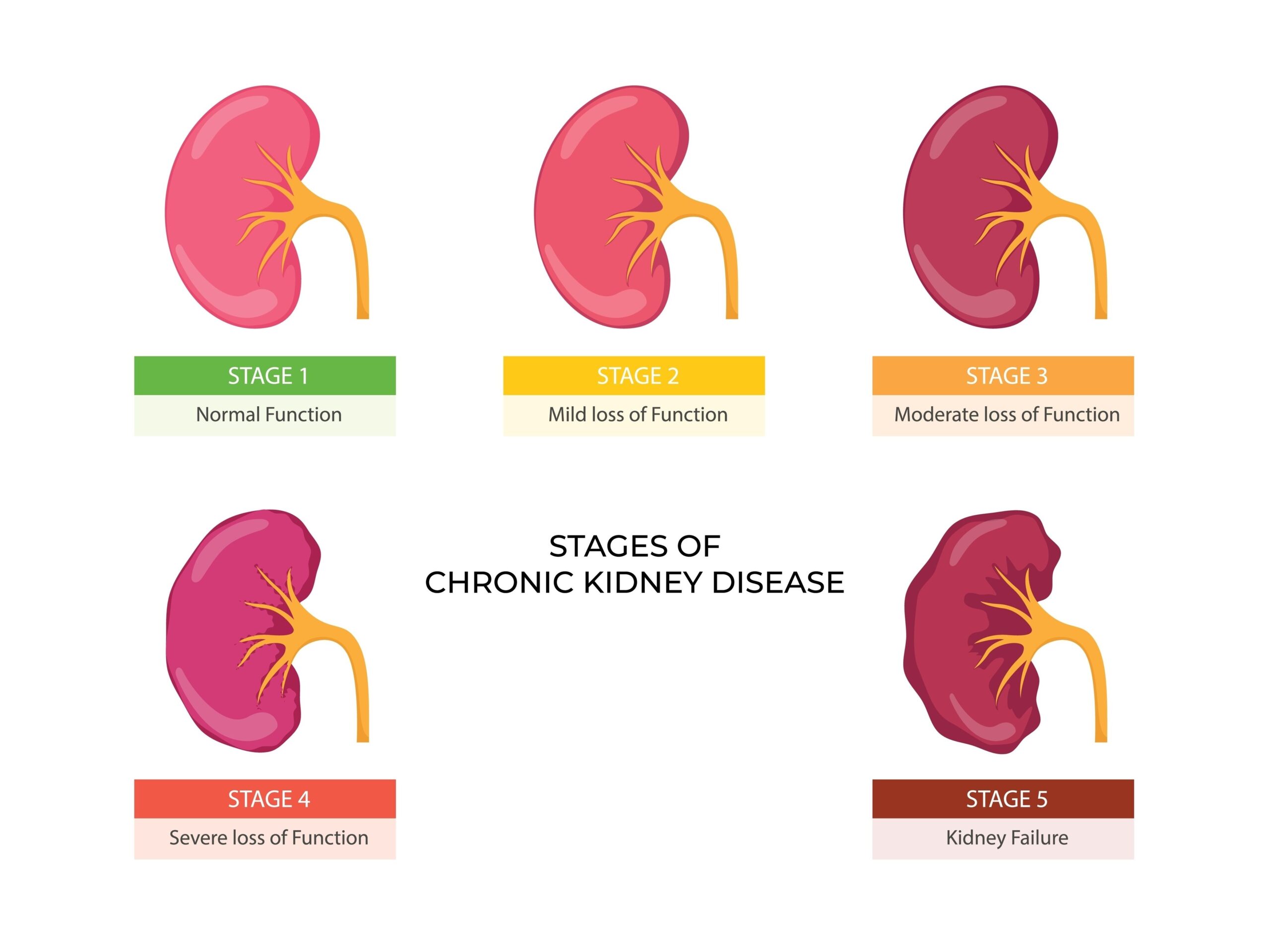 慢性腎臓病（CKD）の状態・症状