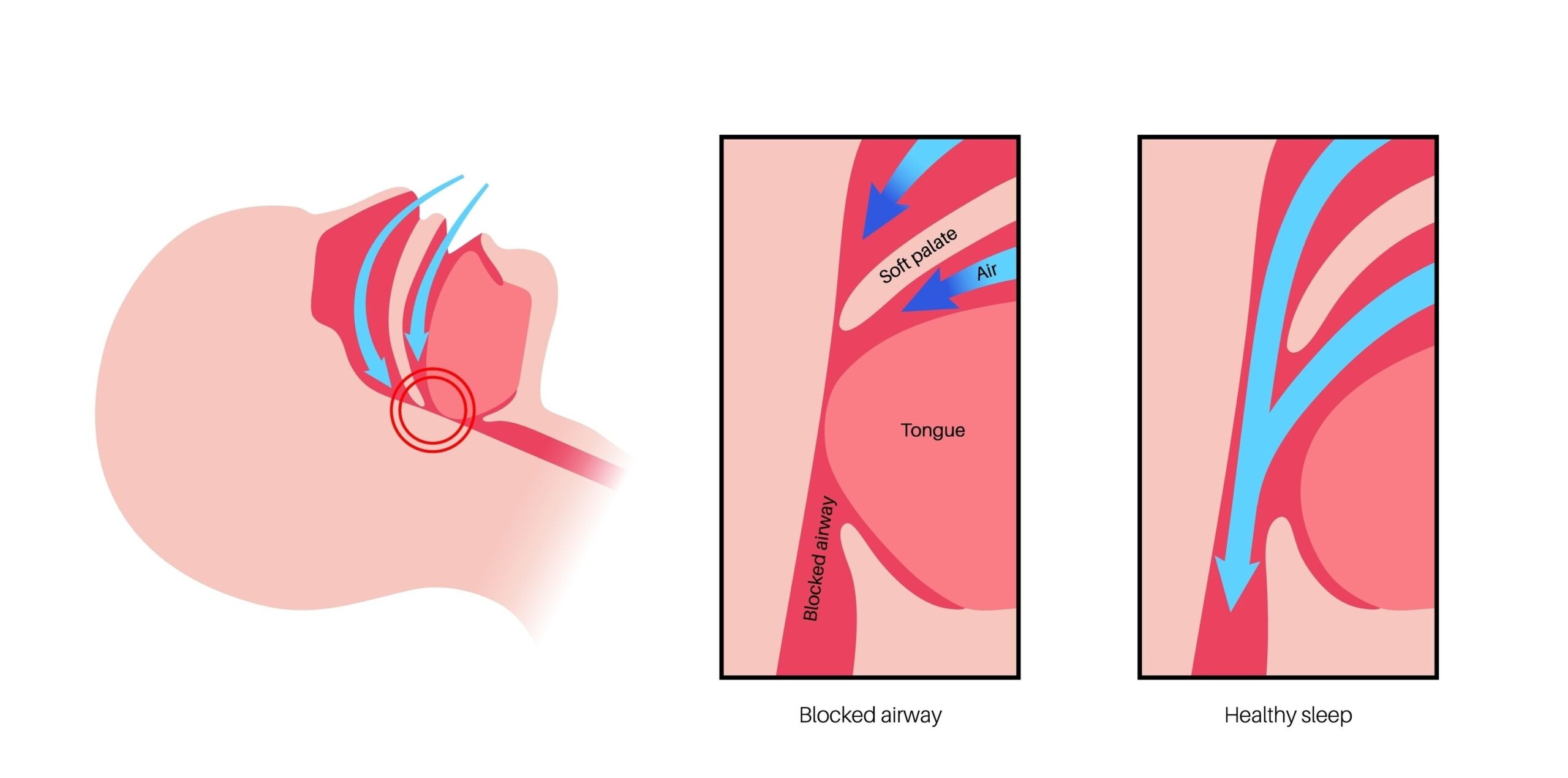 いびきをかく人は睡眠時無呼吸症候群なの? 3 いびきが出る構造・理由