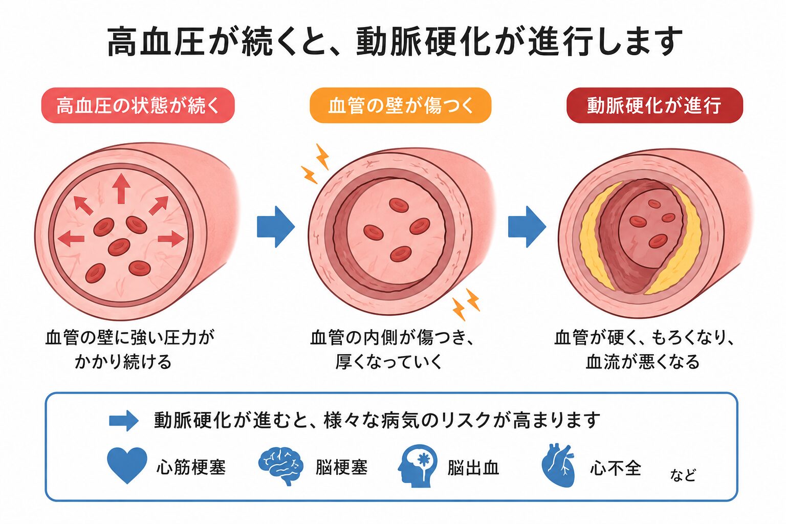 調布市・つつじヶ丘で高血圧を相談したい方へ|血圧が高いと言われたら何をすべき? 2 高血圧証による動脈硬化(調布・三鷹からアクセス良好)