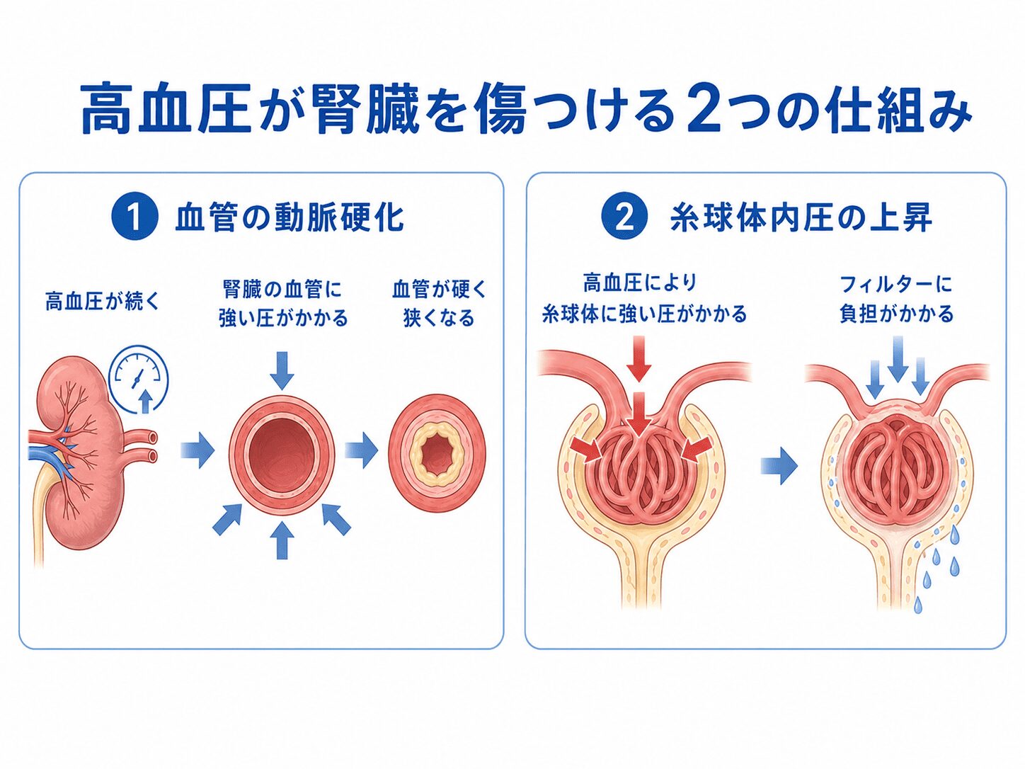 高血圧と腎臓病の関係|腎臓を守るために血圧管理が大切な理由 3 高血圧が腎臓を傷つける仕組み