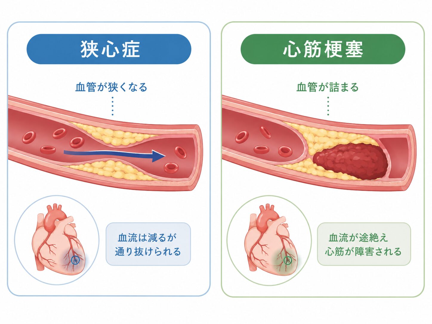 胸痛・胸の違和感がある方へ|調布市の循環器内科 2 狭心症と心筋梗塞で冠動脈がどう変化するかを示す図
